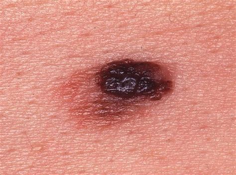 benign moles that look like melanoma